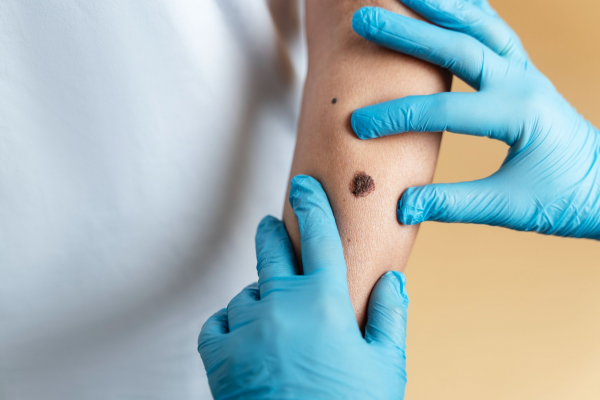 Gejala Kanker Kulit Melanoma